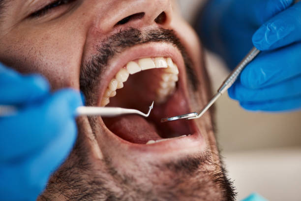 Best Emergency Treatment for Dental Infections or Abscesses in Bloomfield, IA
